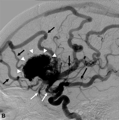 mavc|embolisation malformation artério veineuse.